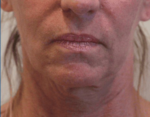 Close-up of a patient's lower face after cosmetic treatment by Dr. Michael BYUN.
