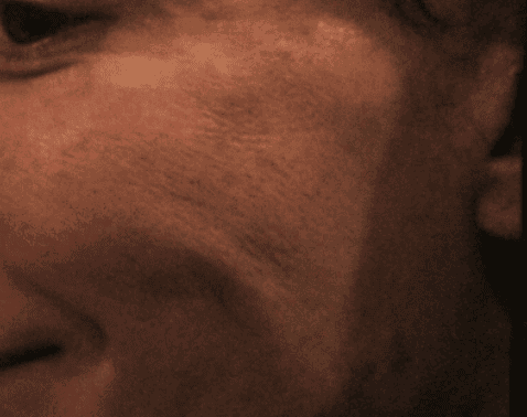 Close-up of skin showing texture and scars for cosmetic evaluation.