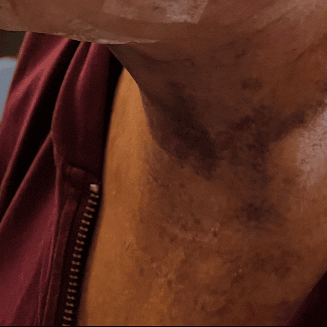 Close-up of skin with discoloration and uneven texture on neck and chest area.