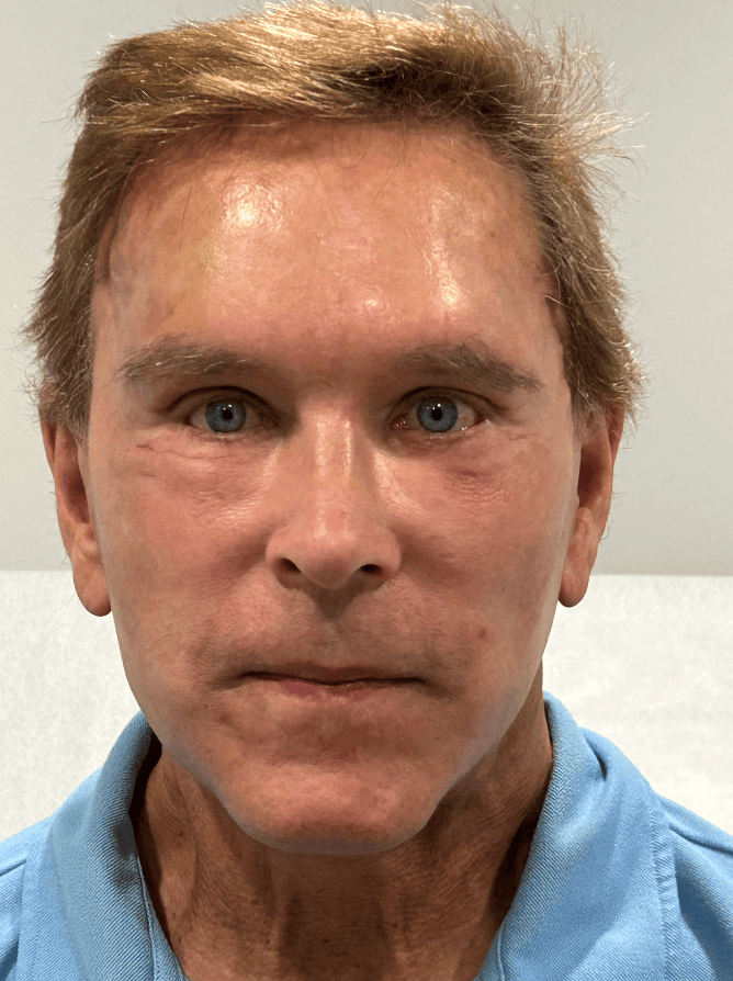 Close-up of a middle-aged man with blue eyes and light brown hair at Chicago Cosmetic Surgery.