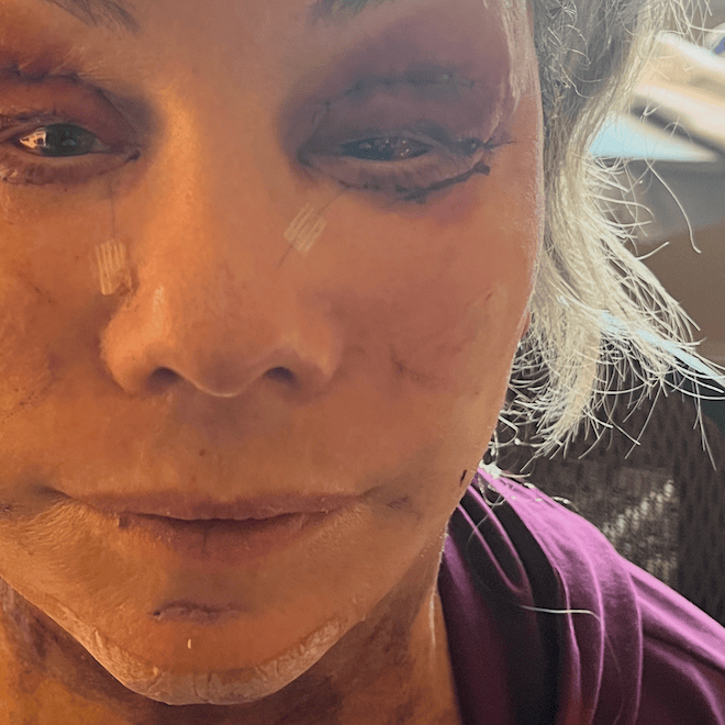 Close-up of a woman with facial scars and swelling after cosmetic procedure.