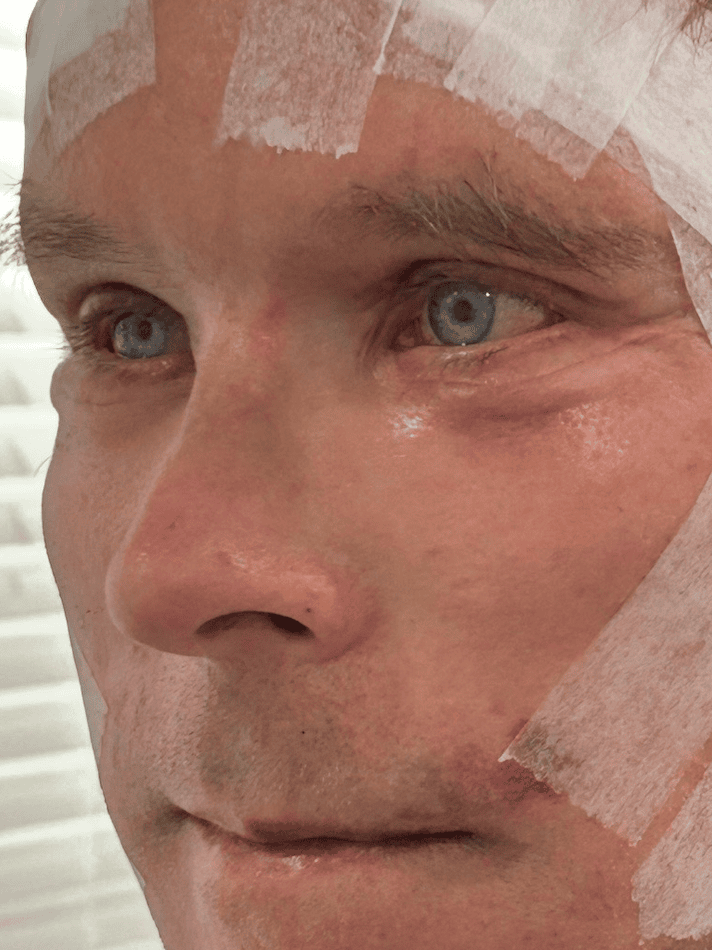 Close-up of a man's face with medical tape before cosmetic procedure by Dr. Michael BYUN.