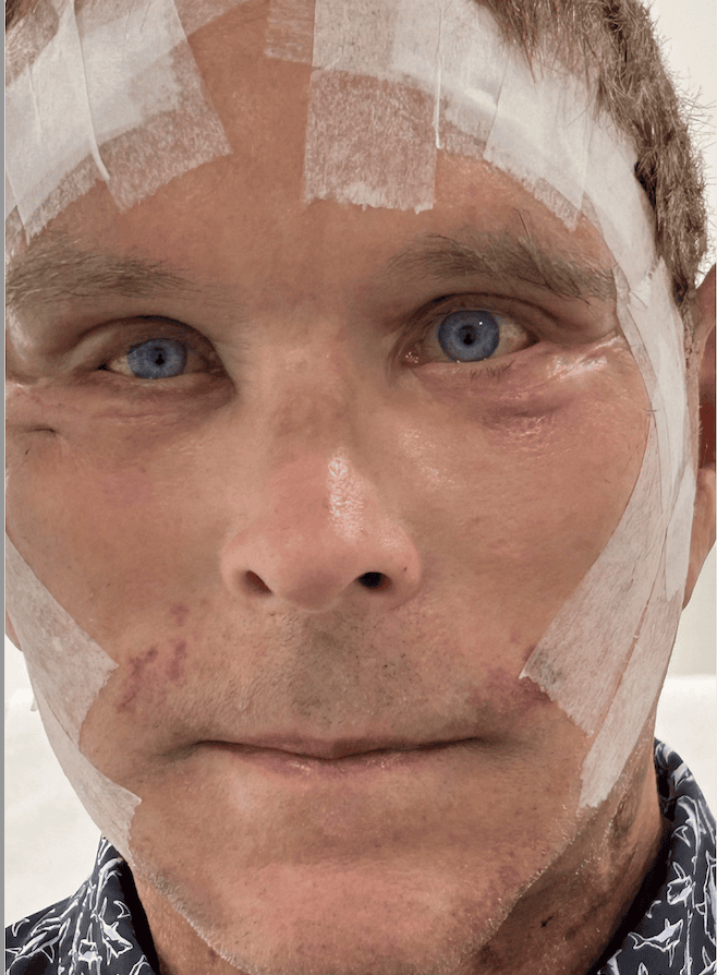 Patient with facial markings for cosmetic surgery consultation.